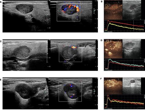 Parotid Gland Tumor Ultrasound