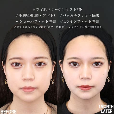 【小顔施術】丸顔から理想の卵型へ｜症例写真・ビフォーアフター｜美容整形･美容外科のtaクリニックグループ