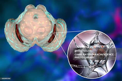 Substantia Nigra In Parkinsons Disease Illustration High Res Vector Graphic Getty Images