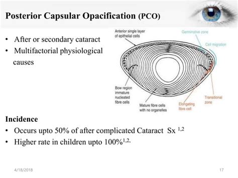 Posterior Capsular Opacification PPT