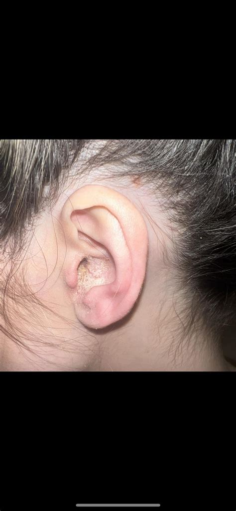 Eczema In Ears R Dermatologyquestions