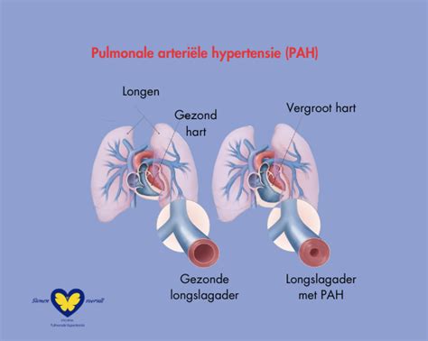 Groep Pah Stichting Pulmonale Hypertensie