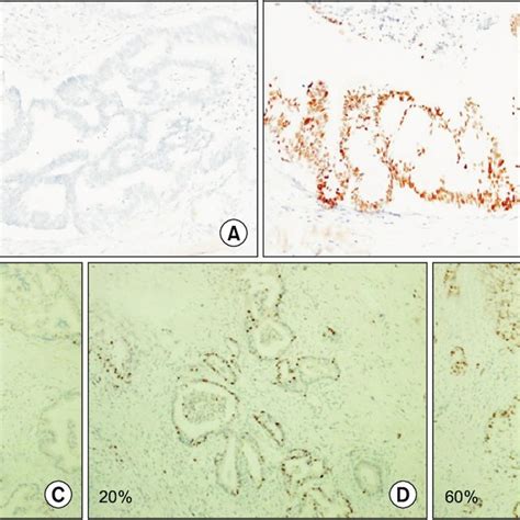 Representative Immunohistochemical Staining Of P53 And Ki 67 In