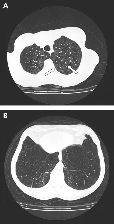 The Hrct Scan Pursuing Real Life Pathology Thorax