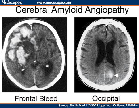 Hemorrhagic Stroke Occipital Lobe