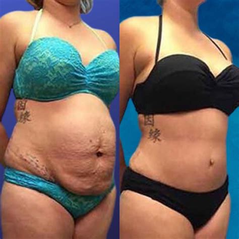 Mini Tummy Tuck Before And After