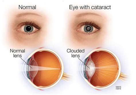 Cataract International Eye Centre