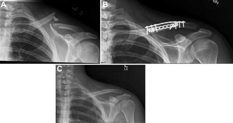 Risk Factors For Hardware Removal Following Operative Treatment Of