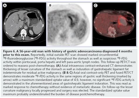 Stomach Cancer On Ct Scan