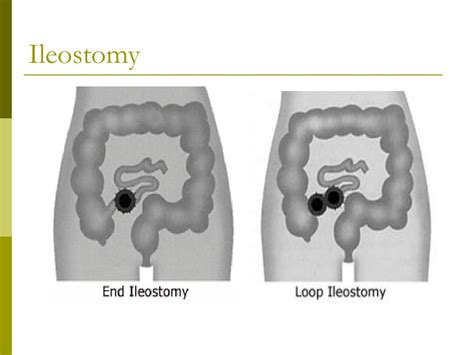 Ileostomy And Mucous Fistula