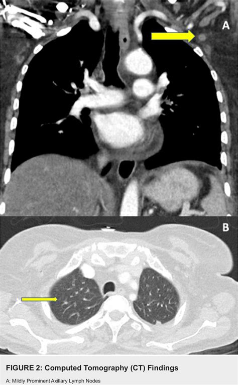 Figure 2 From Primary Cutaneous Gamma Delta T Cell Lymphoma And