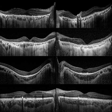 Macular Sd Oct Right Column Right Eye Left Column Left Eye From