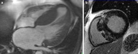 Asymmetric Hypertrophy Of The Interventricular Septum By Cardiac MRI A