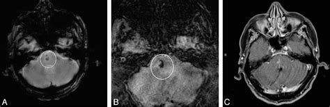 Capillary Telangiectasia Brain Semantic Scholar