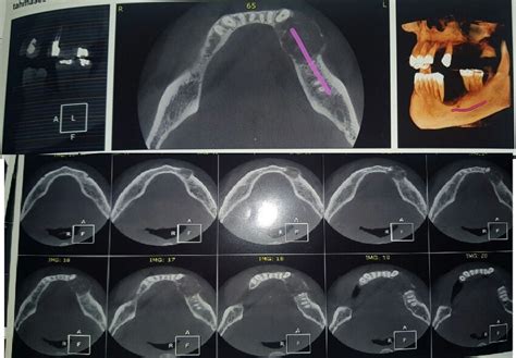 Mandibular Cbct From Areas To Of The Cross Sectional Sections