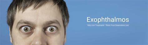 Exophthalmos - IRAN Health Tourism Organizer - Iran Medical Tourism - IRHTO