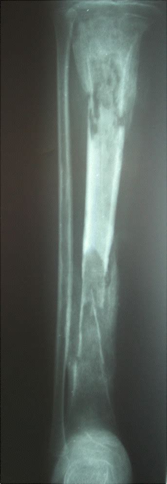 Type B4. Sequestrum present. Non-structural involucrum. Bone defect type | Download Scientific ...