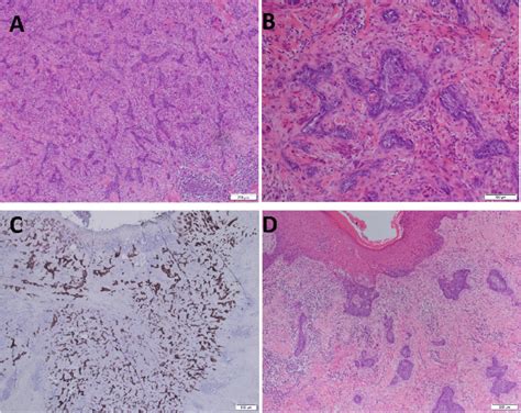 Histopathology Of Basal Cell Carcinoma Showing Infiltrative Growth