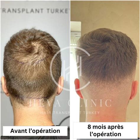 Greffe De Cheveux Zone Donneuse Tout Ce Quil Faut Savoir