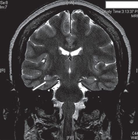 Hippo Campus Mri Sagittal