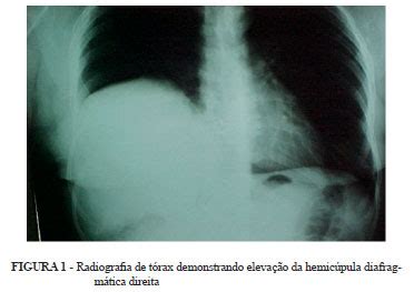 Scielo Brasil H Rnia Diafragm Tica Direita Tardia Associada A