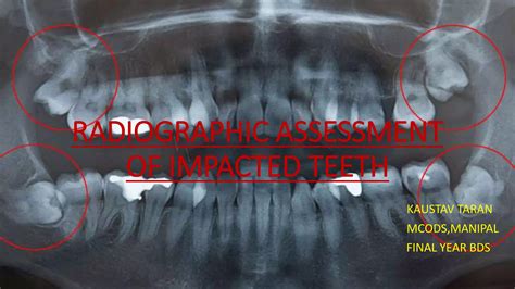 Radiographic Assessment Of Impacted Teeth Ppt