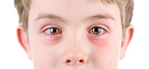 Pink eye: symptoms and treatment - Doig Optometry