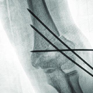 Severe cubitus varus deformity manifests as a pronounced abnormal ...