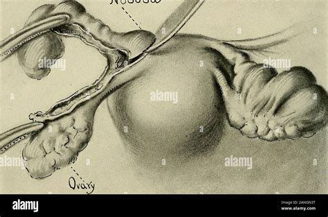 Salpingitis Isthmica Nodosa Hi Res Stock Photography And Images Alamy