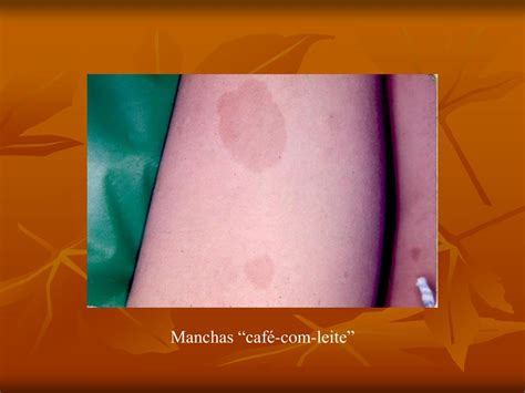 Toda Mancha Café Com Leite E Neurofibromatose