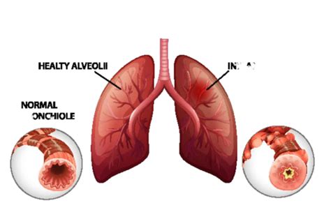 Chronic Obstructive Pulmonary Disease Lung Infographic Info Vector