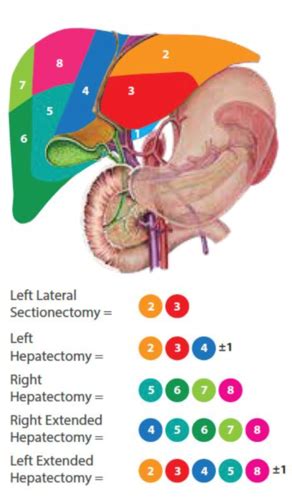 Hepatobiliary And Gi Procedures Part 1 Flashcards Quizlet