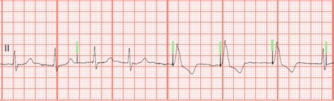 EKG Quiz: Paced Rhythms 335