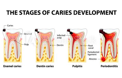 evolucion caries endodoncia 01 Clínica Dental Roca Santiago