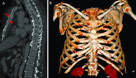 A Sagittal Ct Demonstrating Sternal Fracture Arrow With Subtle