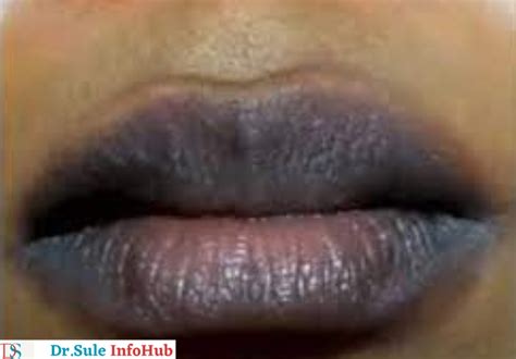 Dark Lips- How to lighten it? - Dr.Sule Info-Hub