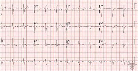 Left Posterior Fascicular Block Ecg Stampede