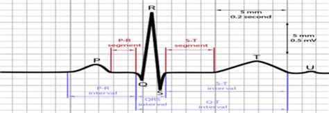 Ekgs Flashcards Quizlet