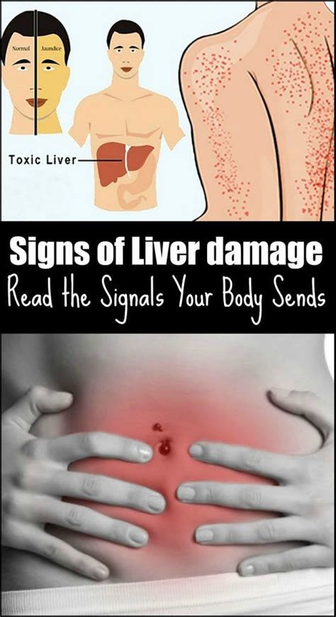 Signs Of Liver Damage Read The Signals Your Body Sends Liver Detox Liver Detox Symptoms