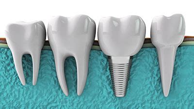 Dental Implants | Plano Dentist | Frisco Dentist | Rabinowitz DDS