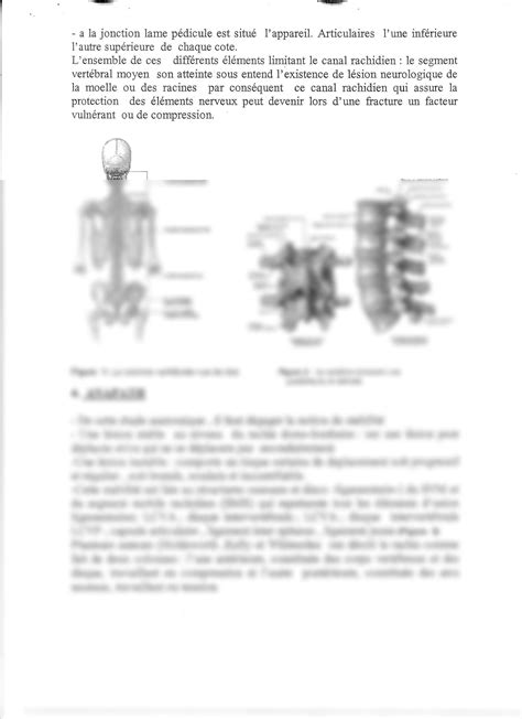 SOLUTION 12 Traumatismes Du Rachis Thoraco Lombaire Polycopi Pr Azzouz