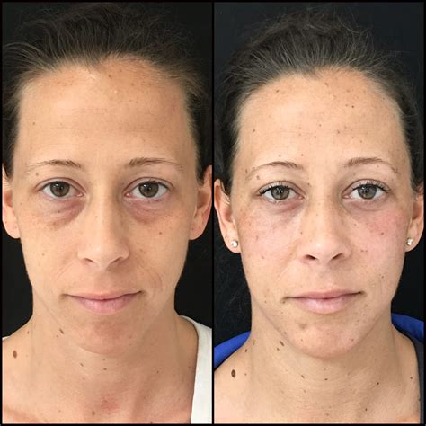 Blepharoplasty Recovery Day By Day