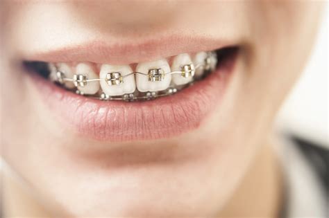 What Age Do Kids Get Braces? How to Tell If Your Child Needs Braces