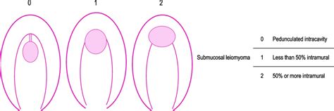 The International Federation Of Gynecology And Obstetrics Leiomyoma Download Scientific Diagram