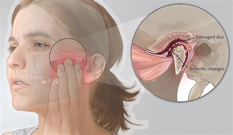 Tempomandibular Pain Illustration By Medical Illustration Studios