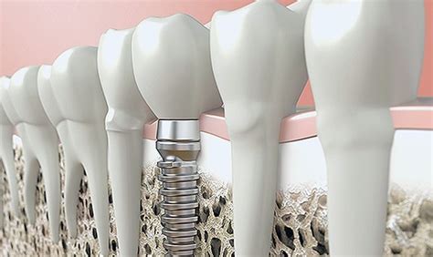 Dental Implant Parts Key Components Revealed