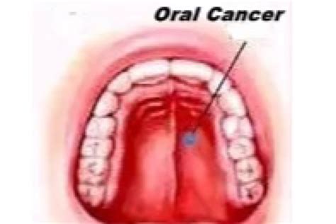 Why India Is Seeing A Rise In Oral Cancer Cases The Statesman