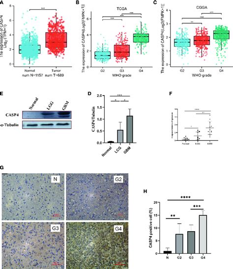 Expression Patterns Of CASP4 In Gliomas A Differential Expression Of