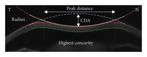 Diagram Illustrating Corneal Deformation Reformation Phases And Corneal