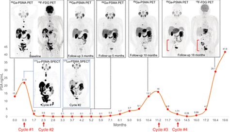 177LuProstate Specific Membrane Antigen Radioligand Therapy In